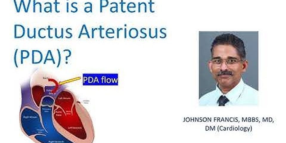 NURSING management of Patent ductus arteriosus SlideShare