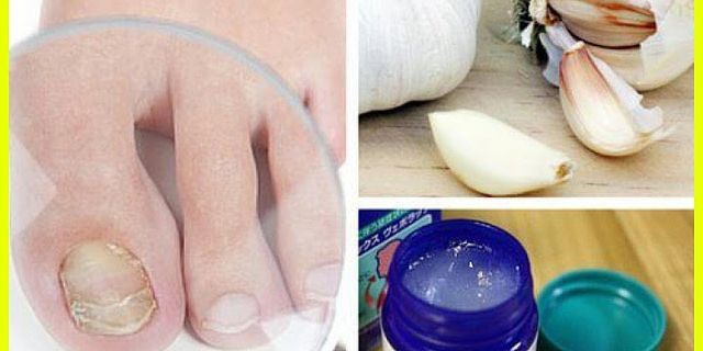 Welche hausmittel helfen gegen nagelpilz